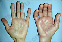 Complex Regional Pain Syndrome 